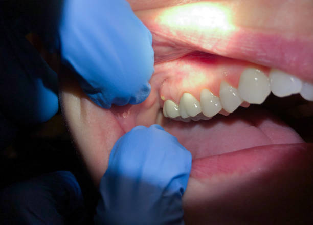 Best Chipped Tooth Repair Near Me  in Pomeroy, WA